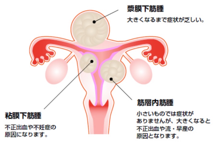 子宮筋腫の説明