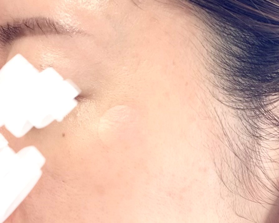 シミ取り後に日焼け止め　おすすめ　　　　　