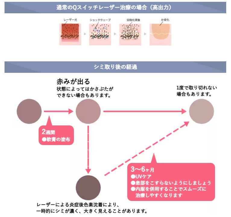 シミ取りレーザーの説明