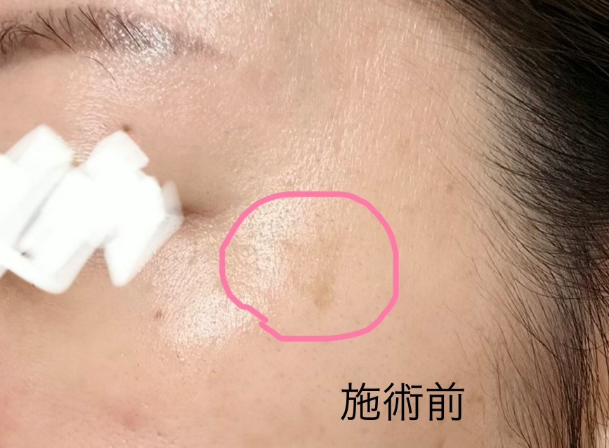 湘南美容クリニックのシミ取りレビュー１