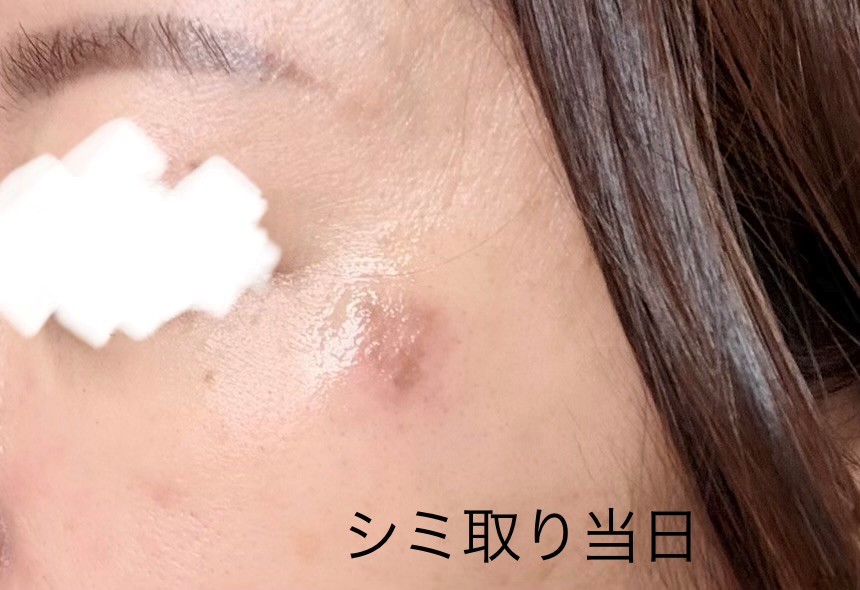 湘南美容クリニックのシミ取りレビュー２