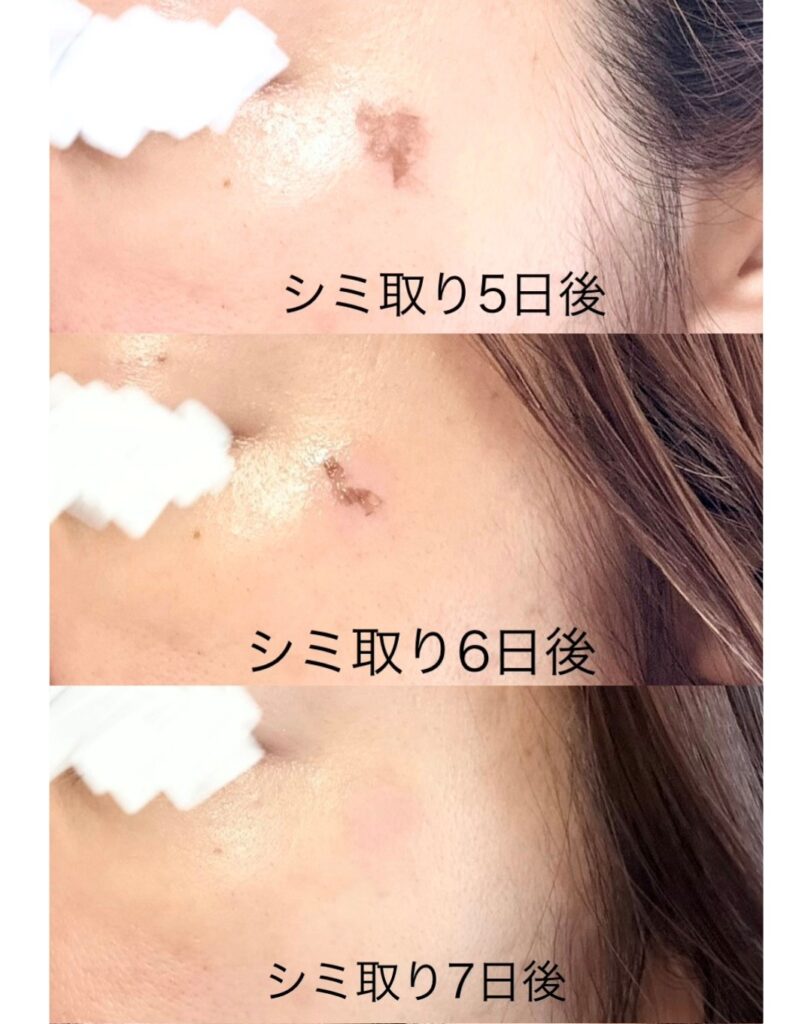 湘南シミ取りダウンタイム経過②