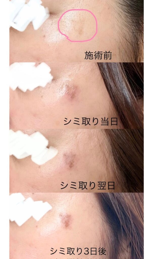 湘南シミ取りダウンタイム経過①