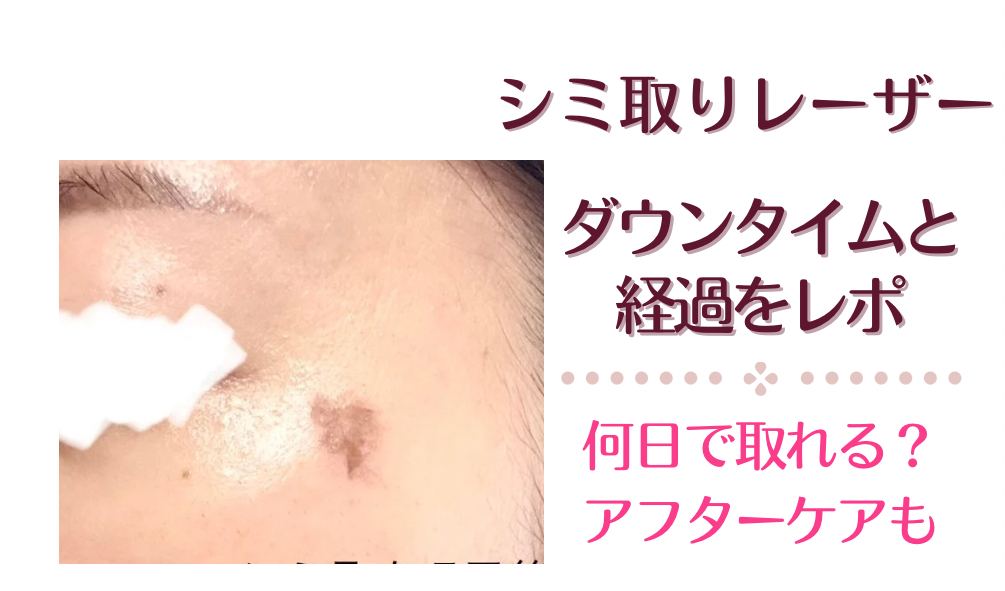 シミ取りレーザーの経過とダウンタイムレポ。テープは必要？価格やアフターケアも。｜キレイイロ*note