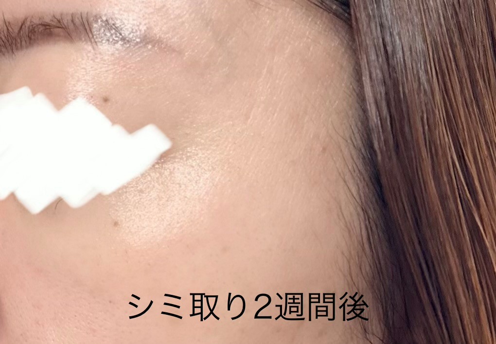 シミ取りレーザー２週間後