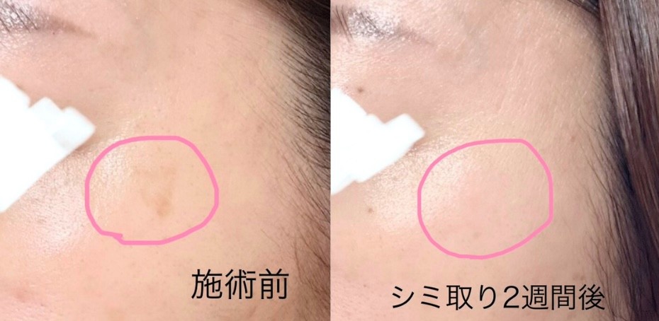 シミ取りレーザー２週間後のビフォアフ
