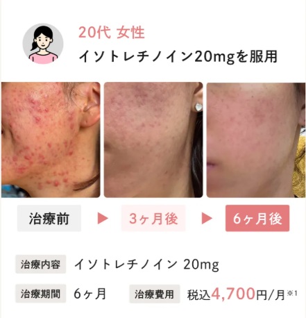 イソトレチノインのニキビ治療症例1