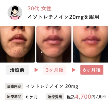 イソトレチノインのニキビ治療症例2