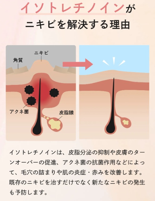 イソトレチノインの効果