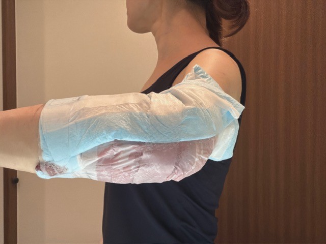 二の腕脂肪吸引注射ダウンタイム