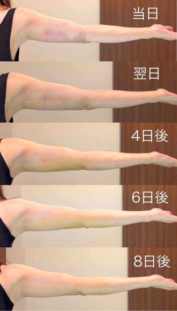 二の腕脂肪吸引注射ダウンタイム画像