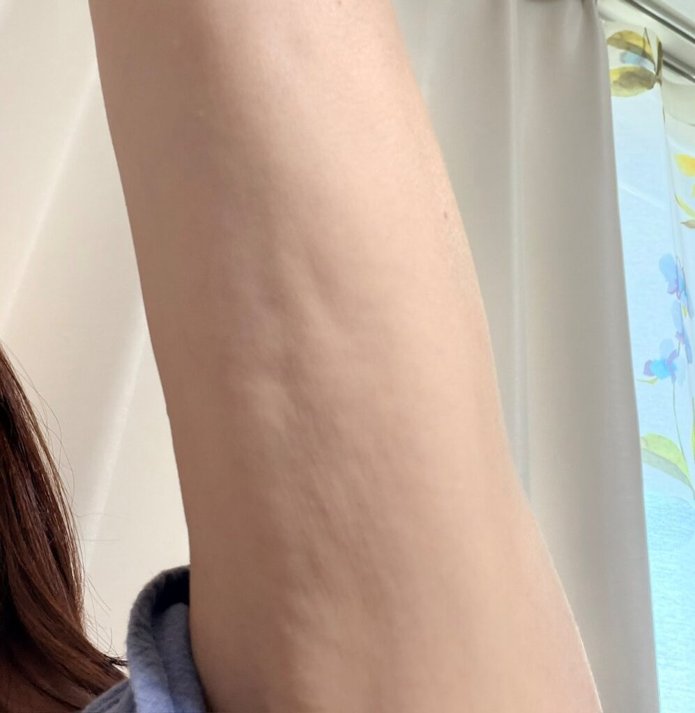 脂肪吸引注射の拘縮