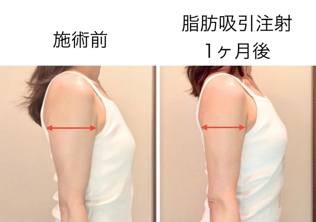 二の腕の脂肪吸引注射1ヶ月後の効果①