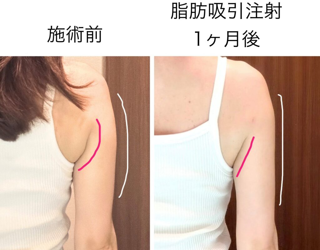 二の腕脂肪吸引注射1ヶ月後の効果②