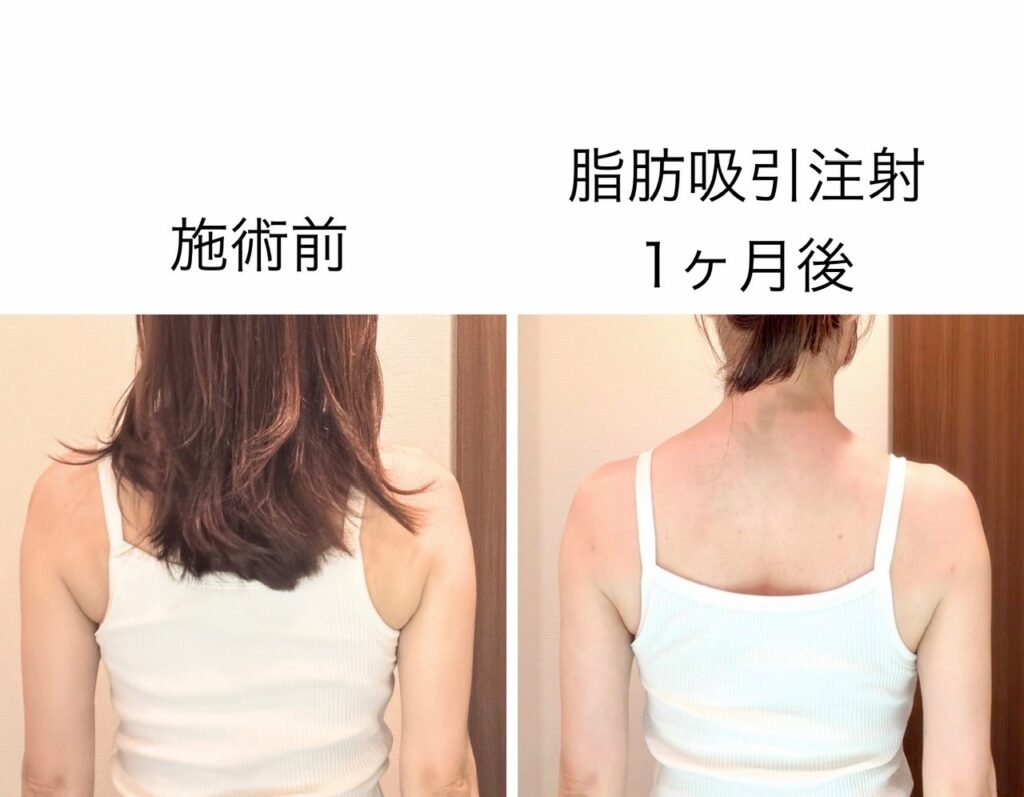 二の腕脂肪吸引注射1ヶ月後の効果④